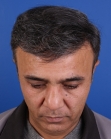 After Hair Transplant&nbsp;Front